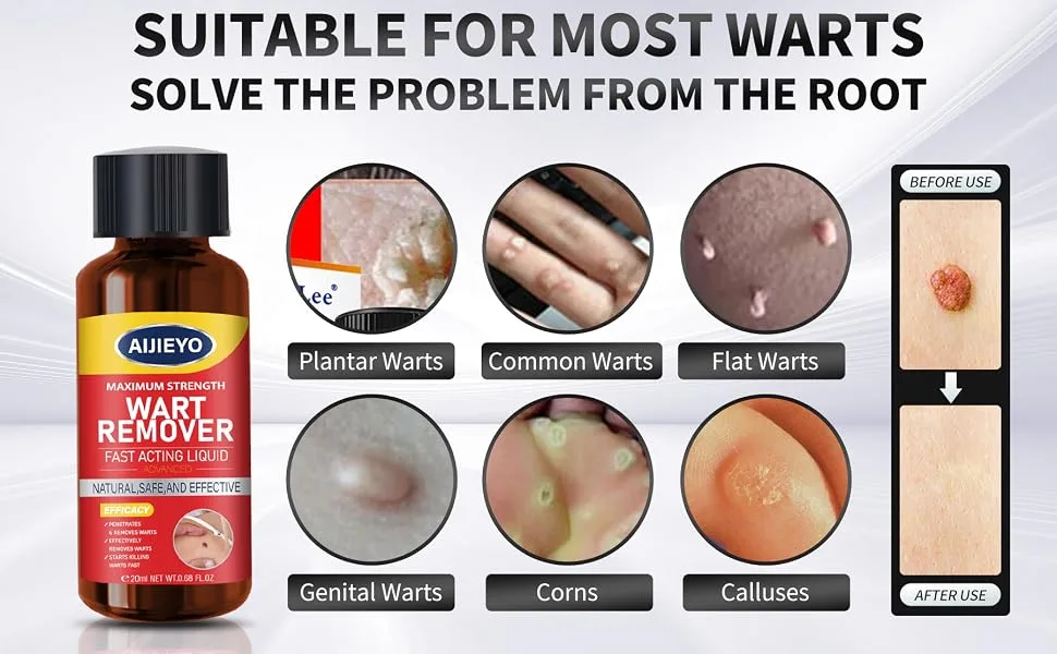 Wart Remover Liquid - Maximum Strength Gel Mask with Exclusive Formula for Swiftly Removing Plantar Warts and Common Warts. Safe Natural and Potent - skin tag remover
