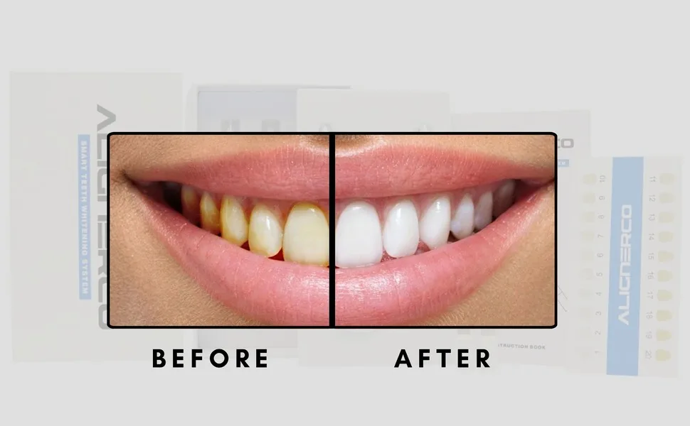 Professional-Grade Teeth Whitening Kit Fast & Effective LED Light & Whitening Gel - Teeth cleaner