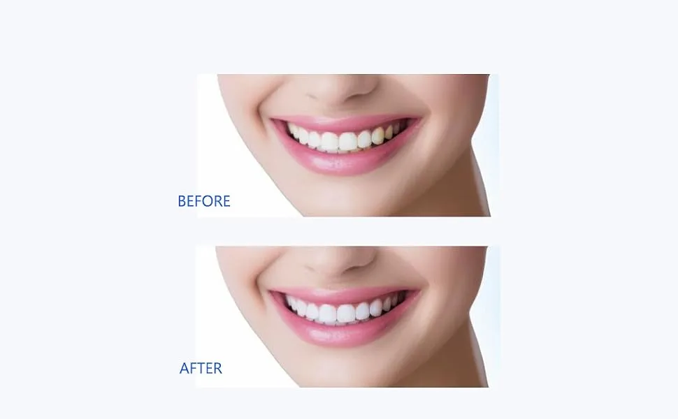 Teeth Whitening Light 32 LED Red & Blue Light Intelligent Teeth Whitening System LED Blue Lights Accelerator with USB for Stain Removal at Home (Black)  - Teeth whitening device