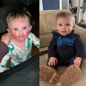 Lavender Aerated Lip Balm tin - Single - Baby with bad eczema before and after pictures. Waxelene healed his face in one week