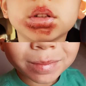 Lavender Aerated Lip Balm tin - Single - boy with extreme chapped lips dry skin ezcema. Waxelene healed the eczema and cracked lips.