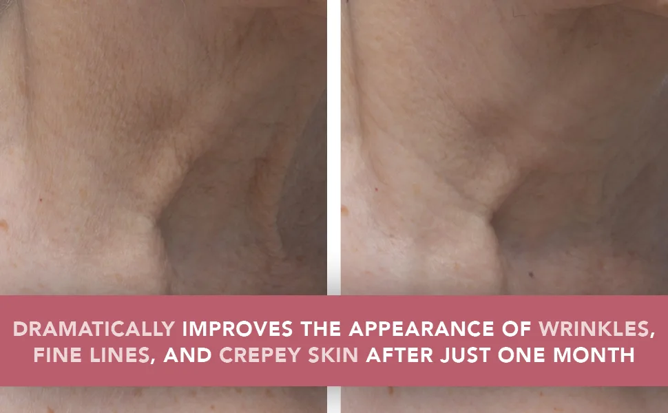 Doll 10 Smooth Assist Toning Neck & Decollete Treatment - Anti-Aging Neck Firming & Tightening Moisturizer Cream - Dramatically improves the appearance of wrinkles, fine lines, and crepey skin after just one month
