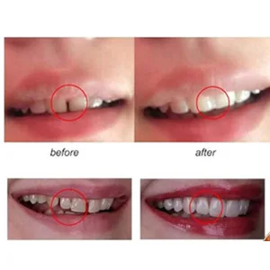 3 colors Temporary Moldable False Teeth Repair Replacement Thermal Fitting Beads Kit for Teeth Instant Confident Smile Teeth - missing teeth repair