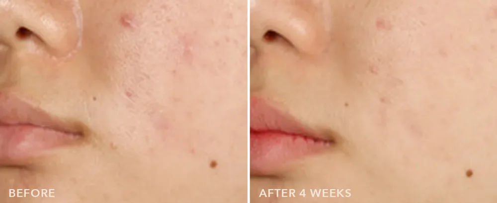 Dr Dennis Gross Alpha Beta On The Spot Eliminator 2% Salicylic Acid Spot Treatment 1 Fl Oz - Acne Prevention Serum