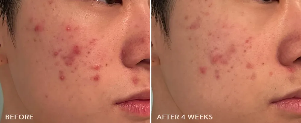 Dr Dennis Gross Alpha Beta On The Spot Eliminator 2% Salicylic Acid Spot Treatment 1 Fl Oz - Non-Comedogenic Formula