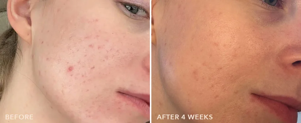 Dr Dennis Gross Alpha Beta On The Spot Eliminator 2% Salicylic Acid Spot Treatment 1 Fl Oz - Oil Control Skincare