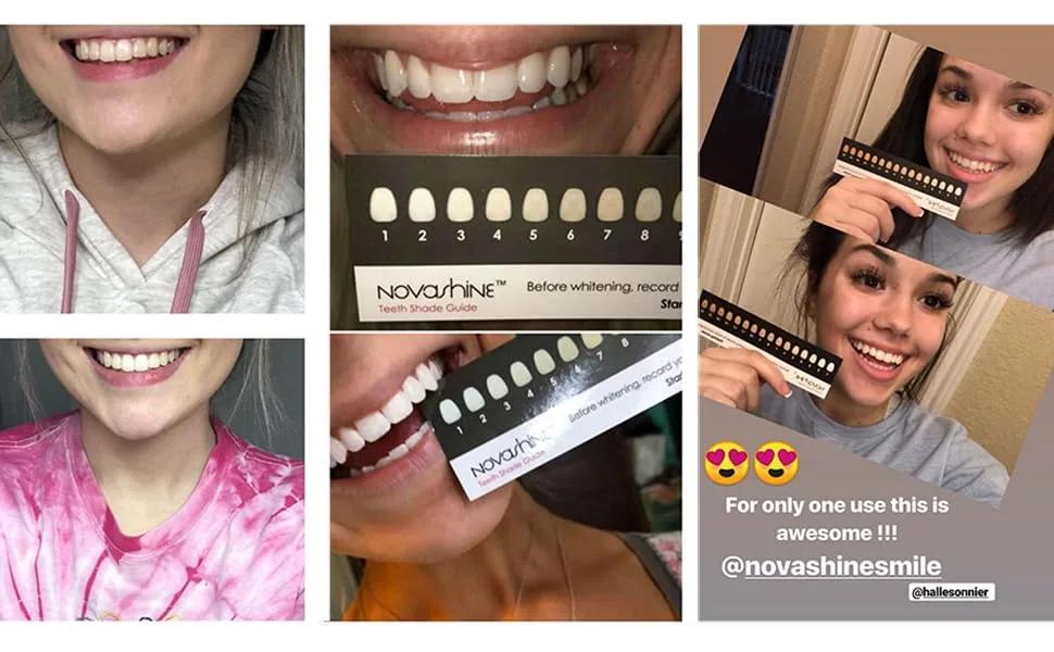 Novashine Professional Teeth Whitening Kit: Advanced Blue LED Light, Concentrated Peroxide Gel, Smartphone Adapter, Travel Bag - Teeth Whitening Results
