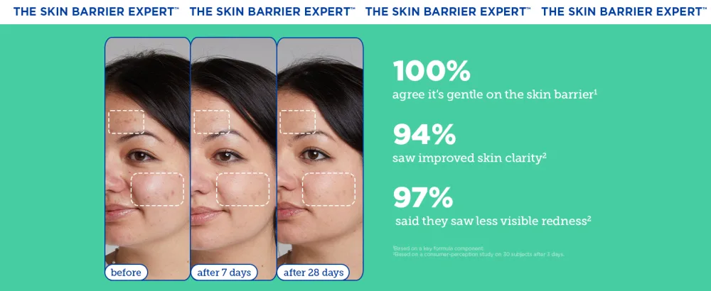 Skinfix Acne+ Adapinoid Gel: Resurface + Clear Acne-Prone Skin Without Irritation While Maintaining a Healthy-Looking Barrier 1 Fl Oz - 100% agree it