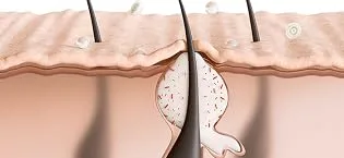 Zitcontrol - Treatment for acne-prone skin - AC-MISSION-FOOTER_2