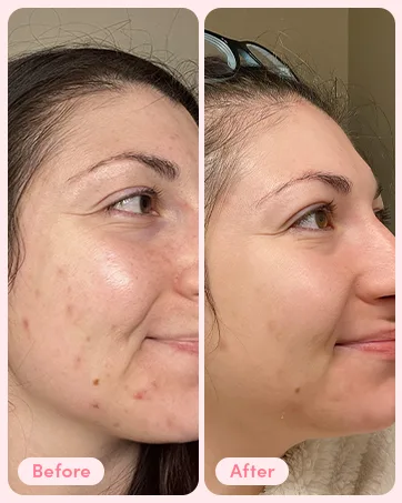 Sand & Sky Pro Youth Dark Spot Serum - Retinol Alternative Bakuchiol Face Cream | For Fine Lines Wrinkles Hyperpigmentation - before and after