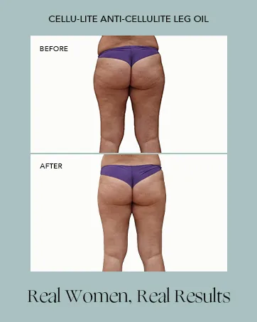 Exfoliating Mitt Buff Lite for Deep Cleansing Lymph Drainage & Skin Priming Dual Sided Shower Pad for Booty & HIPS - Woman before and after using Cellu-Lite Anti-Cellulite Leg Oil with her cellulite reduced