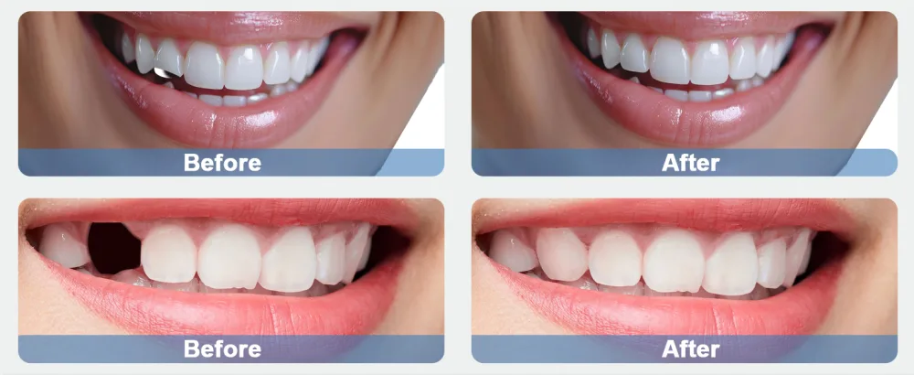 Dental Synthetic Resin Teeth A2 A3 False Upper Lower Teeth Replacement Dentures for Halloween (A2 Full Set 468+U67+34) Full Set 468+U67+34 A2 - effect