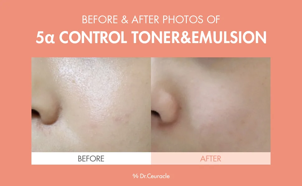 Dr.Ceuracle 5 Control Clearing Serum In Emulsion 100ml - 5 alpha toner emulsion