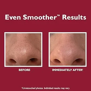 Peter Thomas Roth | Even Smoother Microdermabrasion Exfoliating Pore Purifier - even smoother, microdermabrasion Exfoliating Pore Purifier, results, before and after, b&a