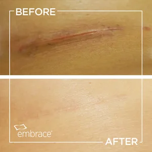 Embrace Active Scar Defense for New Scars FDA-Cleared Silicone Scar Sheets (Size L) 60 Day Supply Large - breast scar