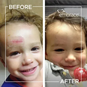 Embrace Active Scar Defense for New Scars FDA-Cleared Silicone Scar Sheets (Size L) 60 Day Supply Large - cuts lacerations