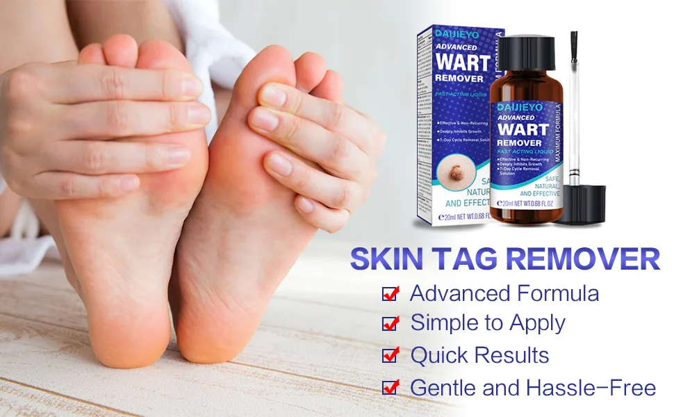 Wart Remover Liquid - Maximum Strength Formula for Rapidly Removing Plantar Warts and Common Warts Safe Natural & Potent Suitable for Most Body Warts (20ml-S03) - wart remover