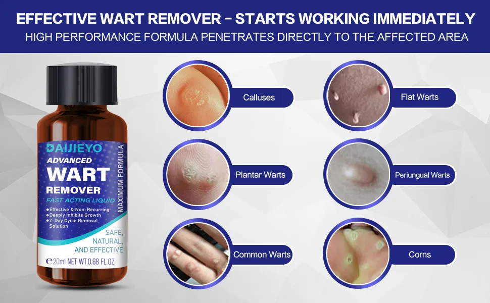 Wart Remover Liquid - Maximum Strength Formula for Rapidly Removing Plantar Warts and Common Warts Safe Natural & Potent Suitable for Most Body Warts (20ml-S03) - wart remover