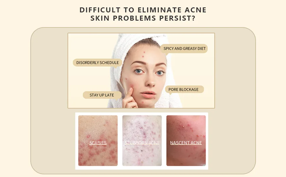 Propolis Ampoule with 60% Propolis Extract for Acne-prone&Sensitive skin No irritation Non sticky Minimize breakouts Hyaluronic Acid 30ml Hydration Support Formula - Difficult to eliminate acne skin problems persist?