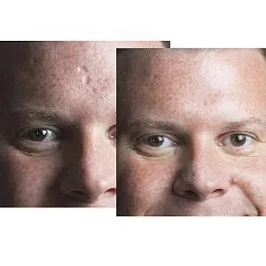 Dermaflage Scar Filler Refill 4 Applicators Fair - Dermaflage covers a chicken pox scar