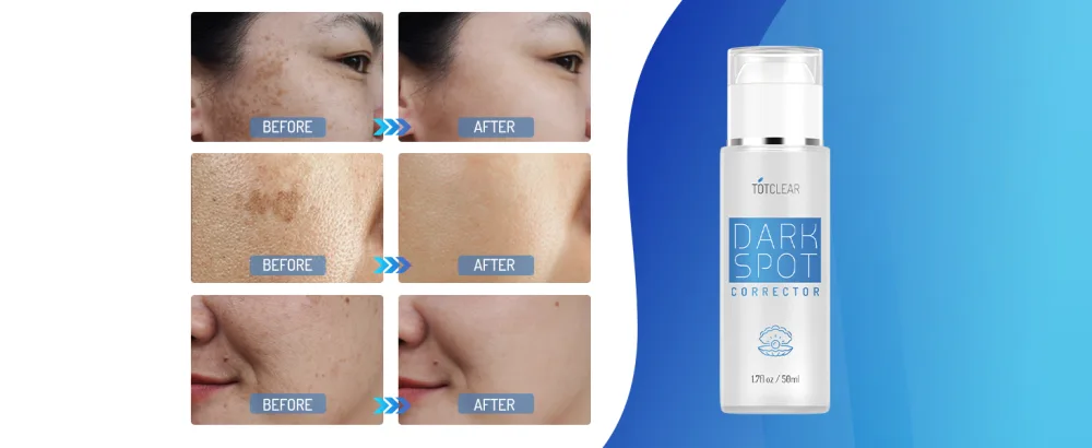 Dark Spot Remover for Face and Body - Before after