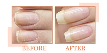 Nail Tek Intensive Therapy 2, Nail Strengthener for Soft and Peeling Nails, 0.5 oz x 1-Pack 0.5 Fl Oz (Pack of 1) Intensive Therapy 2 - Nail Tek Intensive Therapy 2, Nail Strengthener for Soft and Peeling Nails, Thickens Nails