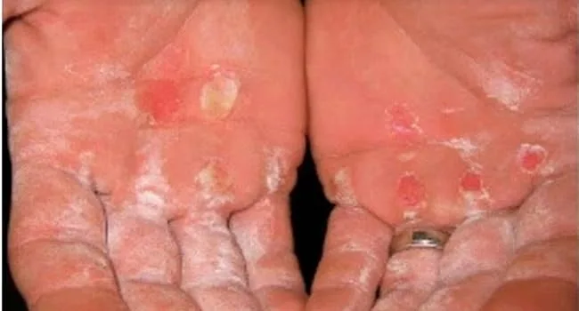 Smoothing Caps - 3 Pack | for Callus Performance Callus Score/Remover - ripped callus on hands