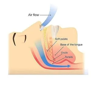 Snoring Solutions - A Simple Solution for Nasal Snorers - by Mobi Lock (Pack of 30 - Large - Various Sizes - Vents Strips and Clips) Pack of 30 - Various Sizes - Vents Strips and Clips - Nose Clip