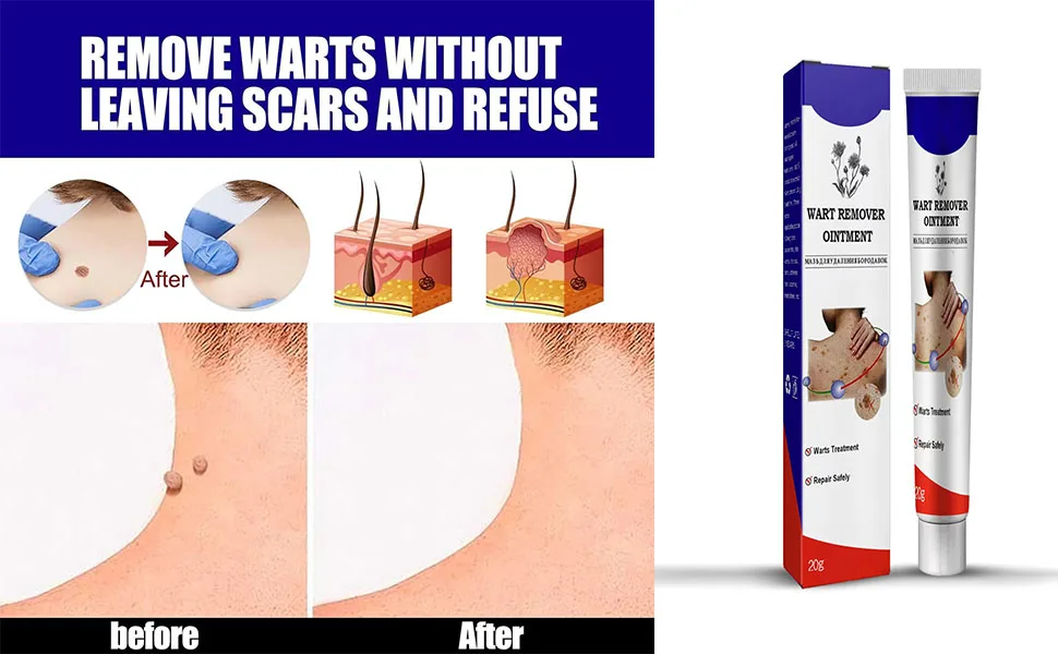 Wart Remover Cream Wart Remover Ointment Fast Acting Cream Wart Gel Maximum Strength.1(PCS) 1pcs - product information 4