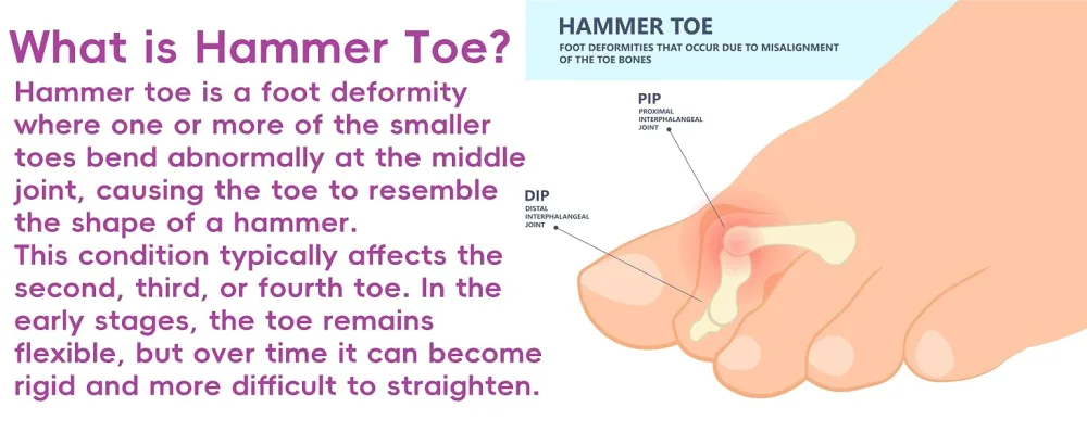 Toe Straightener 6 Pack Gel Toe Splints Hammer Toe Corrector for Women and Men Hammer Toe Cushion Toe Protectors (Large Size White) - hammer toe