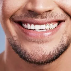 SOIMISS 2pcs Plated Gold Mouth Teeth Top Tooth Single Grill Cap for Teeth Mouth Hip Hop Party Accessories Teeth Grills - product information 4