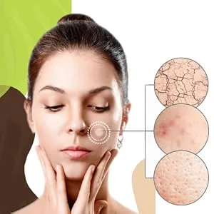 Spot Acne Patch - 72 patches Skin Blemish Treatment with Hydrocolloid | Blemish Acne Dot (Packaging May Vary) 72 Count (Pack of 1) - acne patch hydrocolloid natural