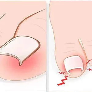 Toe Nail Clippers for Thick Nails Heavy Duty Professional Nail Clippers for Elderly Ingrown Nails Dead Skin Calluses - product information 7