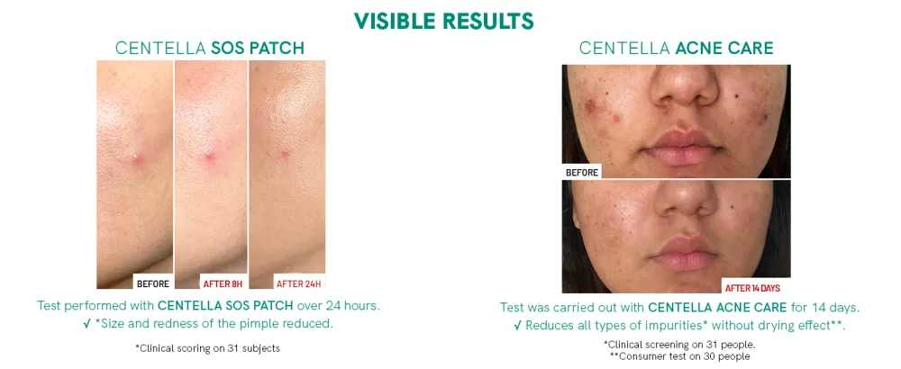 Erborian - Centella Acne Care - Soothing Moisturising Fluid 1% Bakuchiol/Patch Pimple Effect 10% PHA - Acne & Blemish Treatment - Korean Cosmetics SOS Patch - CENTELLA ACNE CARE & SOS PATCH