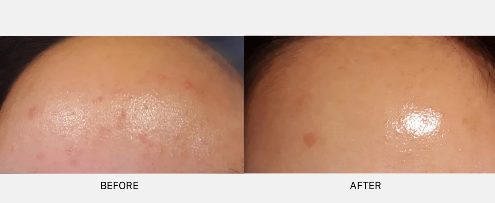  LAB FOR YOU Multi-Ex A.C. Cream | Spot treatment | Korean cosmetics | blemish relief | teatree leaf oil | 20ml/0.7 fl.oz - before and after