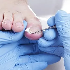 K-Pro Ingrown Toenail Correction Lifter Tool - Help and Corrector for Ingrowing Toe Nail Treatment - for Men & Woman - corner lifter