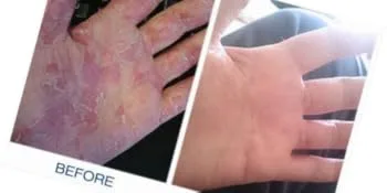 Gloves In A Bottle Shielding Lotion 8oz For Dry Itchy Skin - Before and After