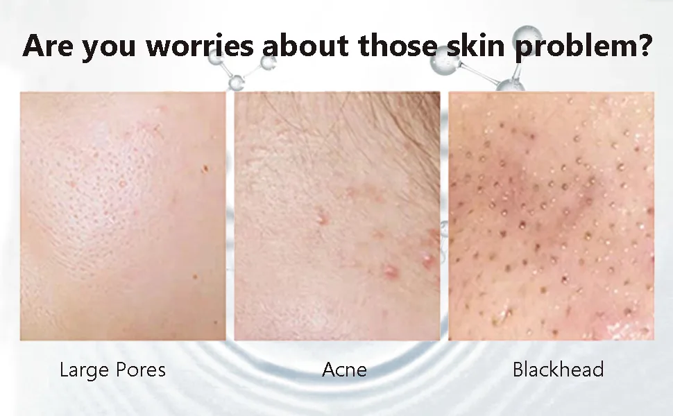 Salicylic Acid Concentrate Super Strong 2% - Acne Spot Treatment - Professional Skincare Serum White 1 - product information 2