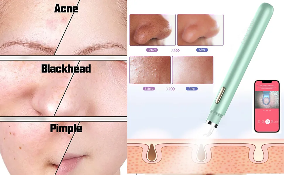 Visible Blackhead Remover with Camera Advanced Pimple Popper with Camera Acne Comedone Whitehead Extractor Kit Skin Care Pore Clean Tool - Visible Blackhead Remover with Camera