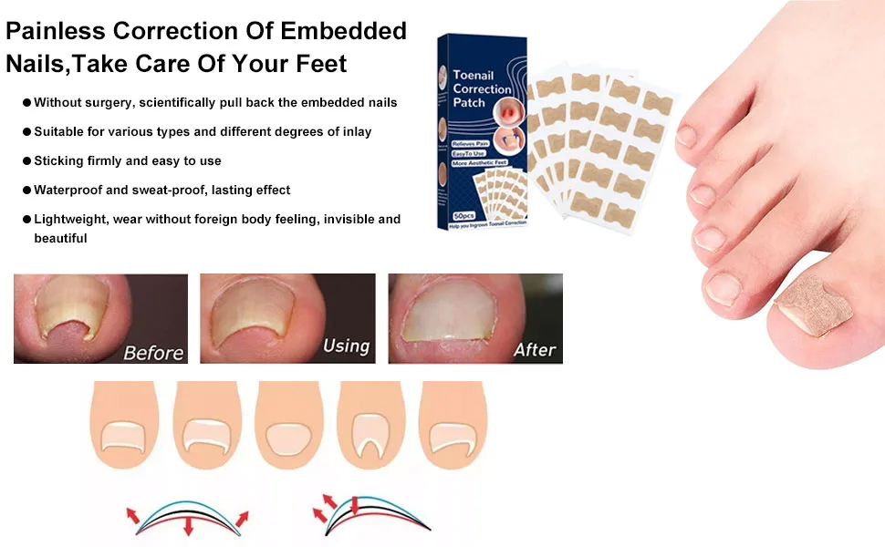 Toenail Patch Toenail Correction Patch Toenail Correction Patch Corrector Pedicure Ingrown Toenails Tool for Ingrown Toenails 50 Pieces - product information 3