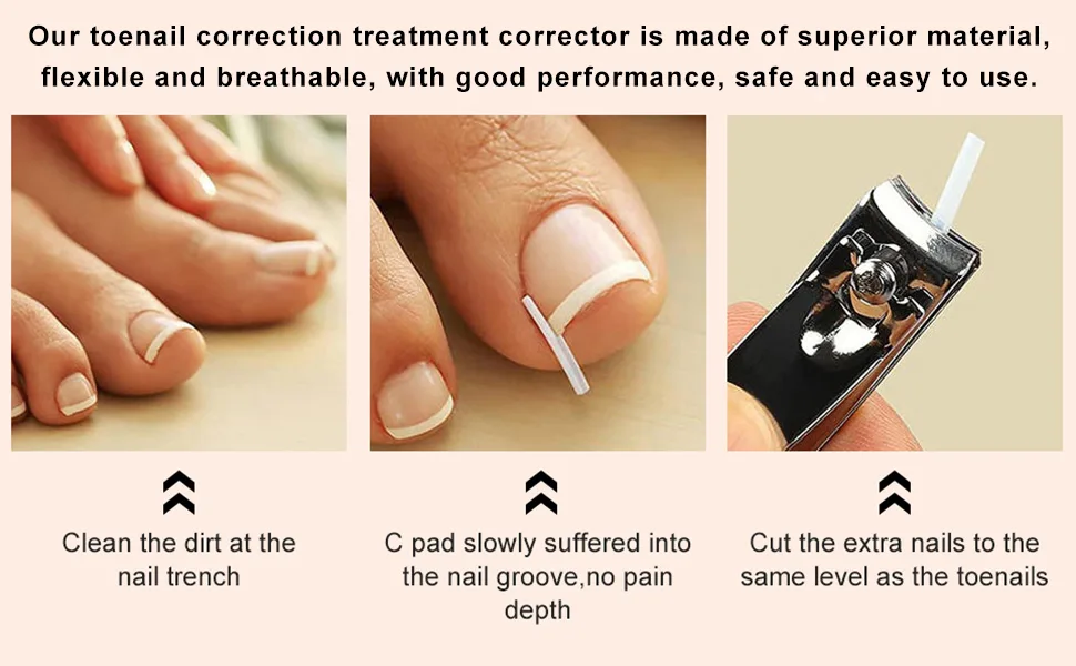 Toenail Corrector Patch Ingrown Nail Corrector Ingrown Nail Treatment Ingrown Nail Corrector Stickers Toenail Correction Toenail Patch - product information 3