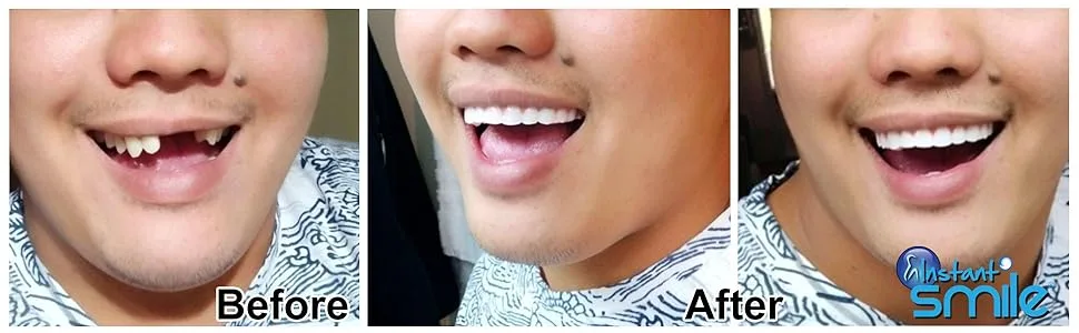 Instant Smile Comfort Fit Flex - Bright White - Upper Veneer Cosmetic Teeth - Instant Smile Comfort Fit Flex Cosmetic Upper teeth before and after