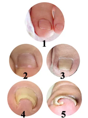 Ingrown Toenail Corrector Strips Brace 10pcs/bottle Straightener Clip Curved BS Brace Toenails Thick Correction Foot Tool - Ingrown Toenail Pedicure Tool