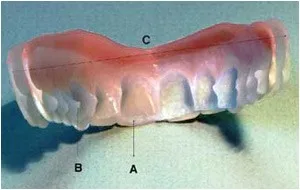 Imako Cosmetic Teeth 1 Pack. (Small, Bleached) Uppers Only- Arrives Flat. Fit at Home Do it Yourself Smile Makeover! 1 Count (Pack of 1) - product information 5