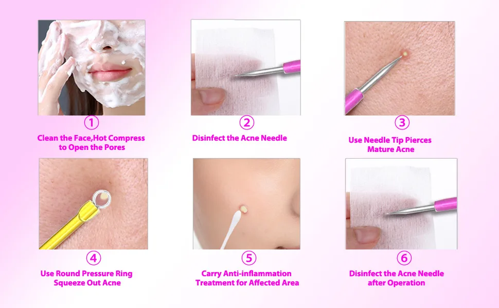 Glamne Blackhead Remover Pimple Popper Kit Acne Comedone Extractor Blemish Extraction Popping Tools (Rosy Yellow) - blackhead remover tool