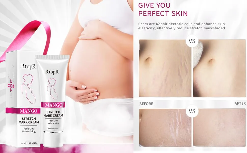 Stretch Mark Removal Cream Obesity Stretch Mark Moisturizer Postpartum Repair Stretch Mark Cream Abdominal Stretch Mark Cream Remove Marks (2 PCS) - renshenwen-11
