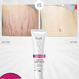Stretch Mark Removal Cream Obesity Stretch Mark Moisturizer Postpartum Repair Stretch Mark Cream Abdominal Stretch Mark Cream Remove Marks (2 PCS) - renshenwen-15