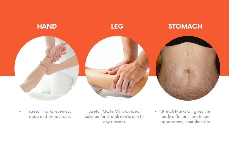 Stretch Marks Oil is an ideal solution for stretch marks due to any reasons (Pack of 2) - Apply Hand Leg & Stomach