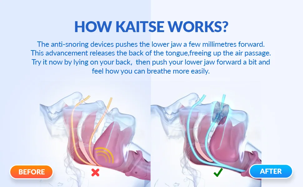 Kaitse Anti Snoring Devices for Sleep: Snoring Solution - Anti Snoring Mouth Guard - Effective Anti-Snoring Mouthpiece Stop Snoring - Anti Snoring Devices for Sleep