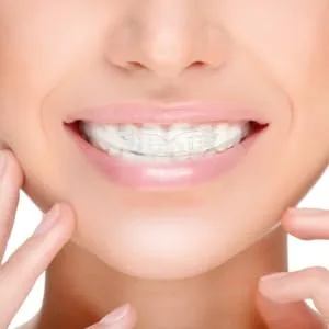 1Pc Practical Durable Exquisite Portable Adult Brace Teeth Straightening - product information 4